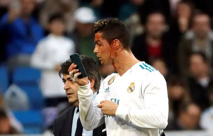 Ronaldo chảy máu đầm đìa trên mặt sau pha ghi bàn